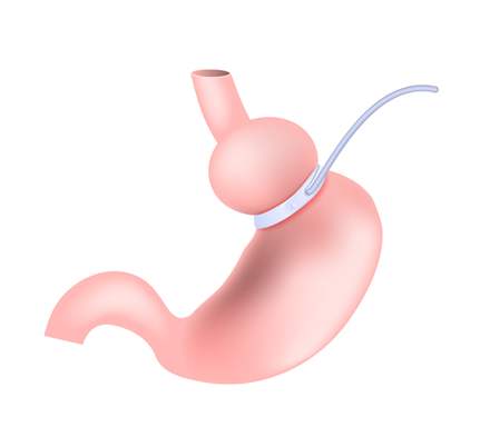 تركيب وازاله ربط المعدة في تونس بسعر رخيص ورأي مفضل