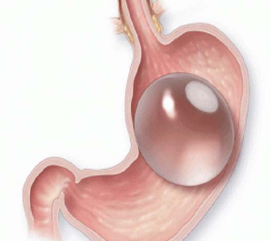 تركيب بالون المعدة في تونس بسعر رخيص مع تقييمات مرضية مناسبة