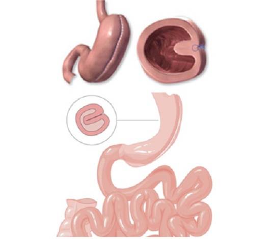 طي المعدة في تونس بسعر رخيص مع آراء مؤاتية