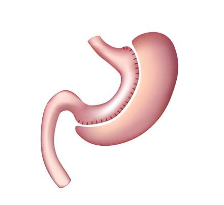 تكميم المعدة في تونس بسعر رخيص مع رأي مفضل من المرضى